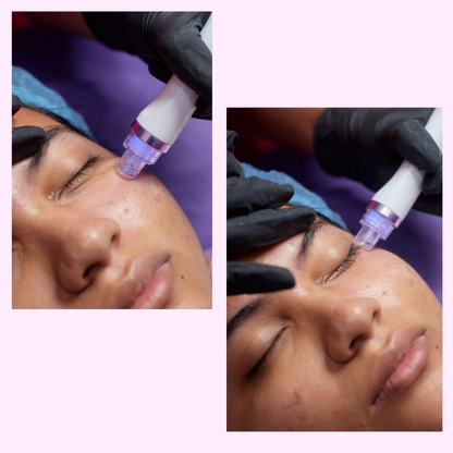 HYDRAFACIAL