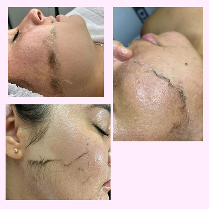 DERMAPLANIG FACIAL